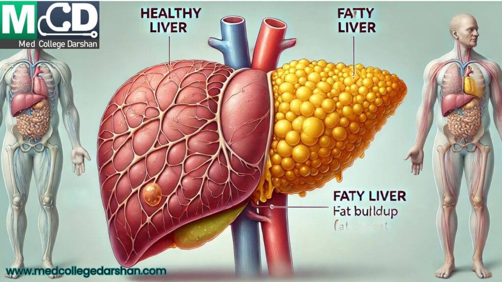 Fatty liver
