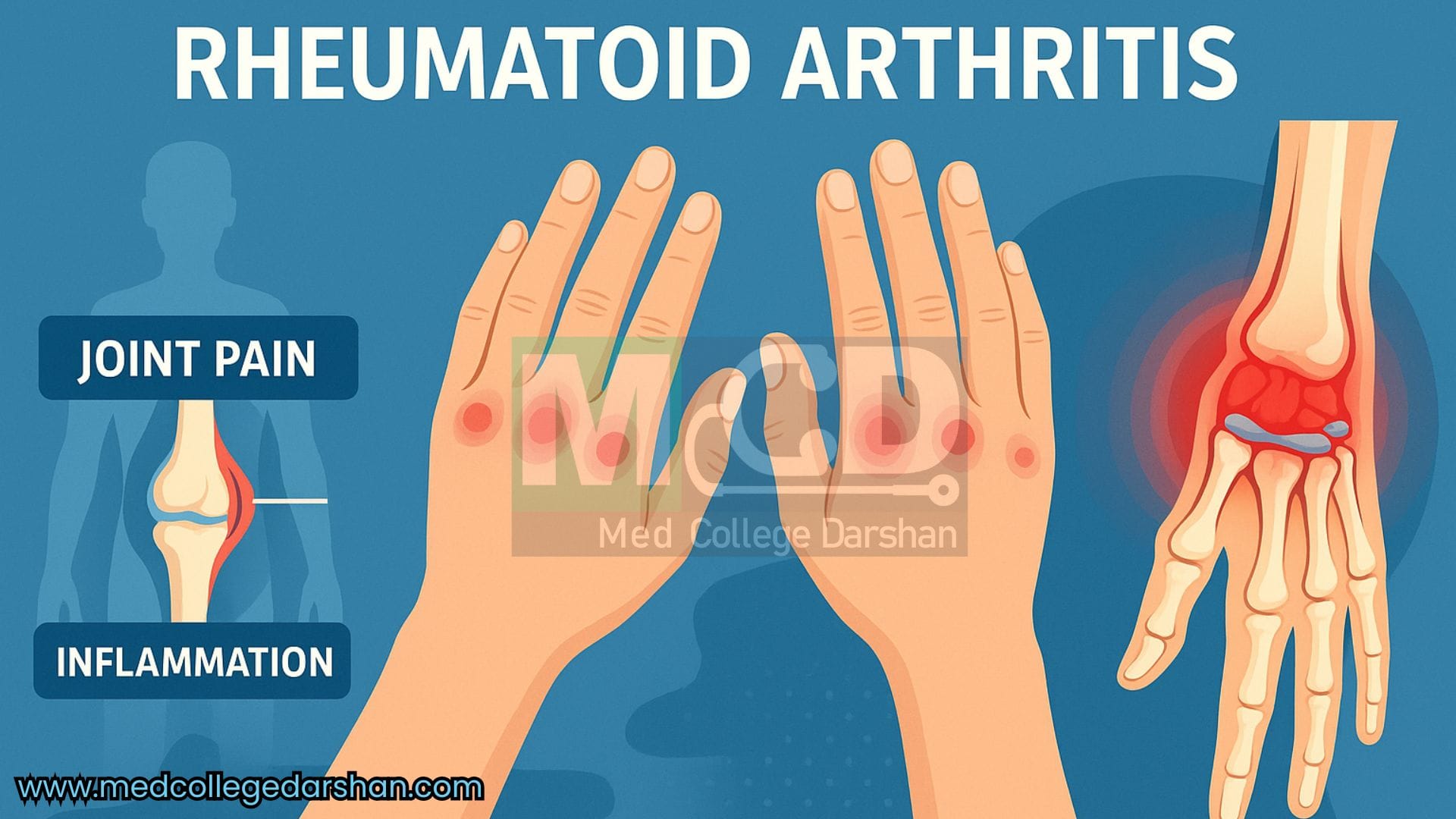 Rheumatoid arthritis